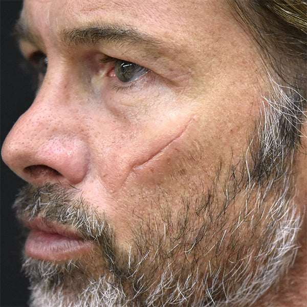 Out Of Kit Peel N&#39; Stick Prosthetics, Sunken Scar 7