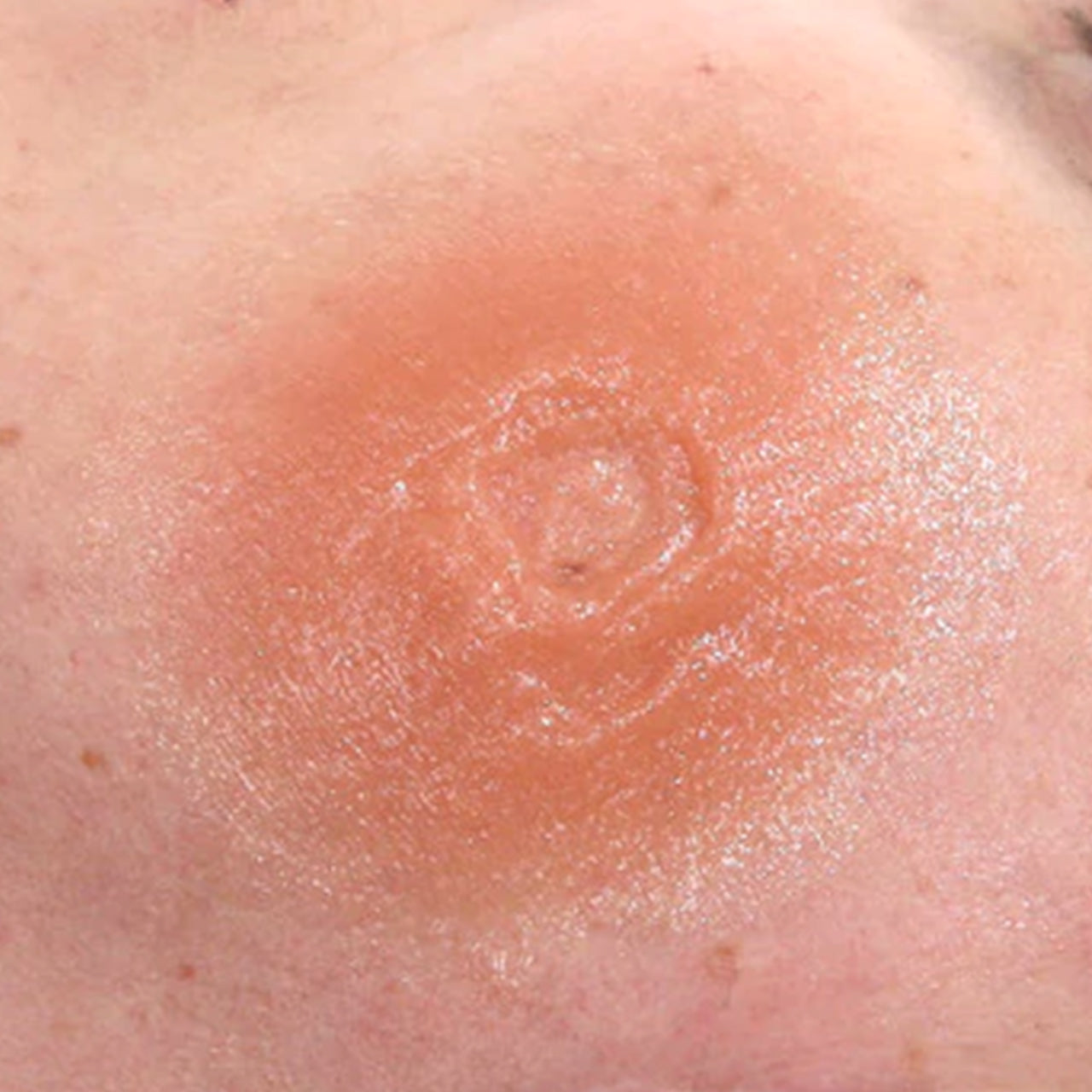 Prosthetic Transfer Material Bullet Hole Molds Entry .45 Calliber